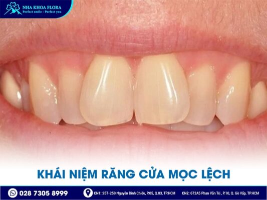 răng cửa mọc lệch - ảnh 1
