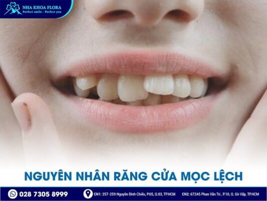 răng cửa mọc lệch - ảnh 2