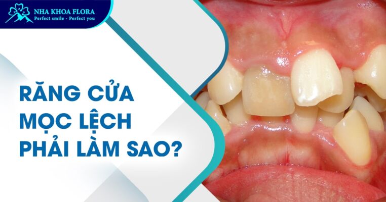 răng cửa mọc lệch