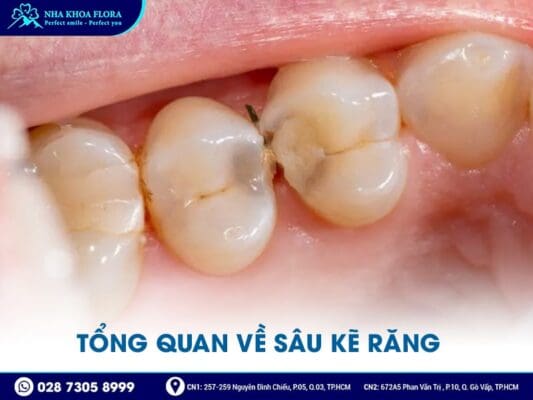 sâu kẽ răng - ảnh 1