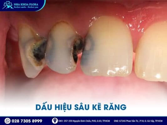 sâu kẽ răng - ảnh 2