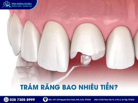 Trám răng bao nhiêu tiền? - Ảnh 1