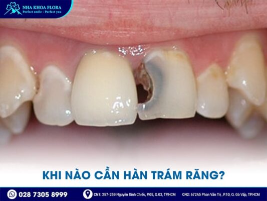 Trám răng bao nhiêu tiền? - Ảnh 3