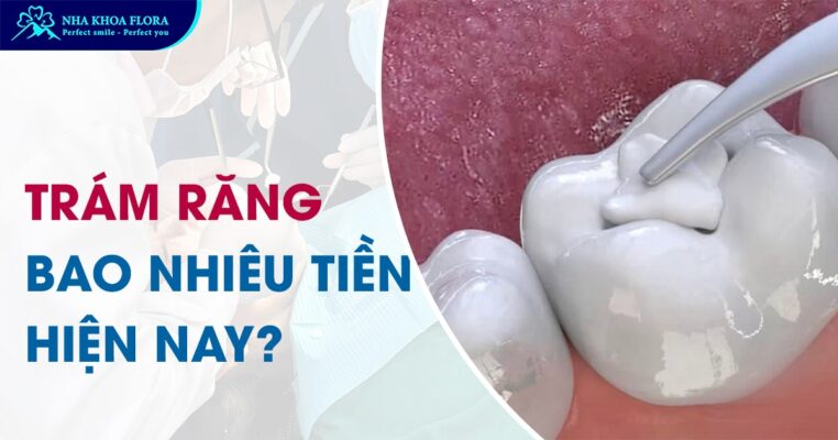 trám răng bao nhiêu tiền