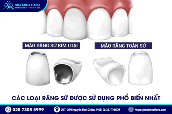 Bảng Giá Bọc Răng Sứ 1