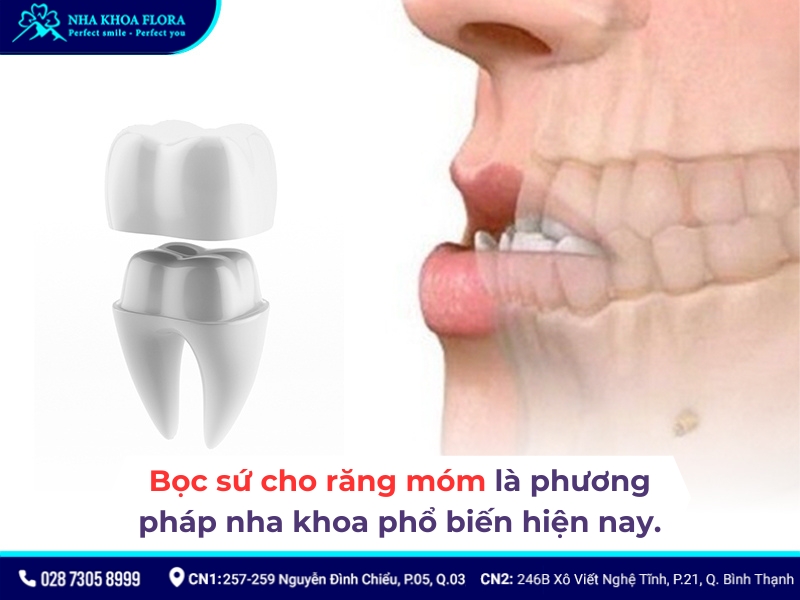 bọc răng sứ có hết móm không