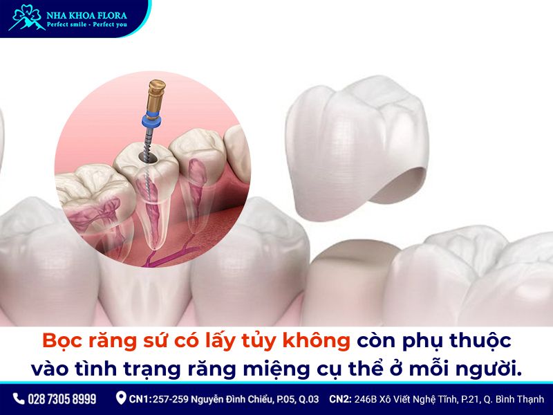 bọc răng sứ có lấy tủy không