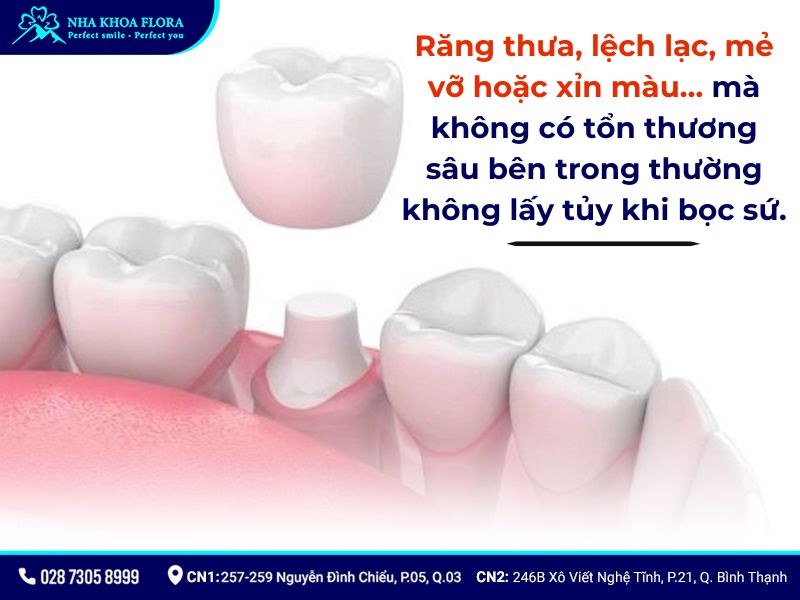 bọc răng sứ có lấy tủy không