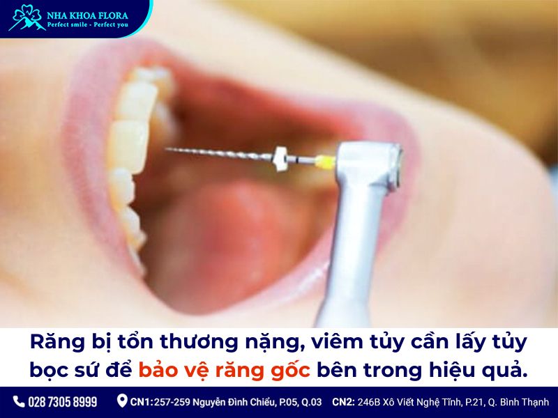 bọc răng sứ có lấy tủy không