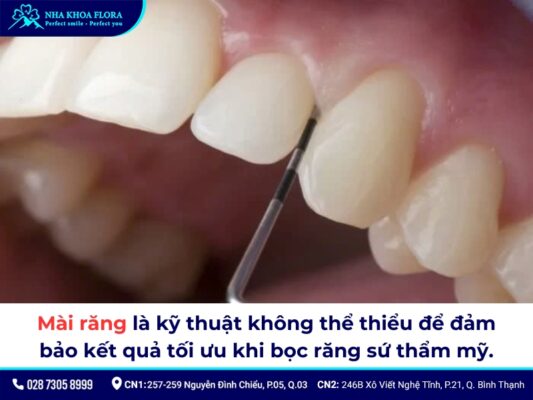 mài răng bọc sứ - ảnh 1