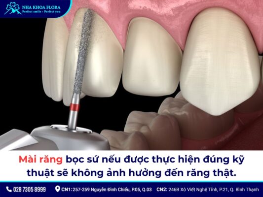 mài răng bọc sứ - ảnh 2