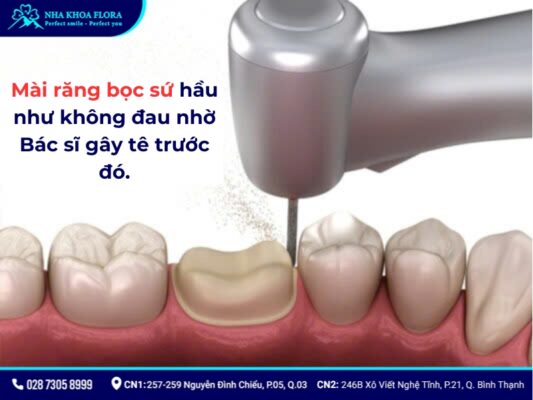 mài răng bọc sứ - ảnh 3