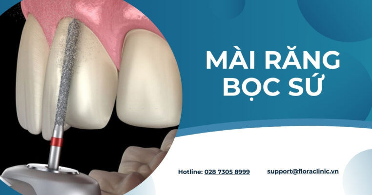 mài răng bọc sứ