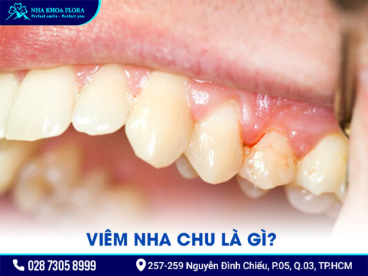 Bị nha chu có bọc răng sứ được không? - ảnh 1