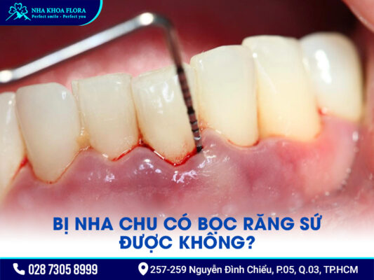 Bị nha chu có bọc răng sứ được không? - ảnh 2