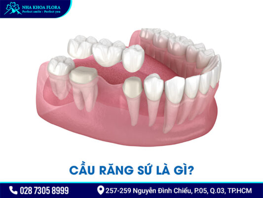 Cầu răng sứ - ảnh 1 Cầu răng sứ - ảnh 1