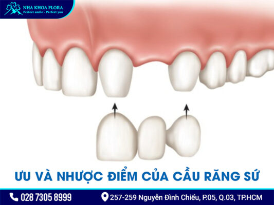 Cầu răng sứ - ảnh 2 Cầu răng sứ - ảnh 2