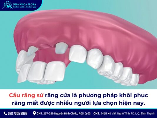 Cầu răng sứ răng cửa - ảnh 1 Cầu răng sứ răng cửa - ảnh 1