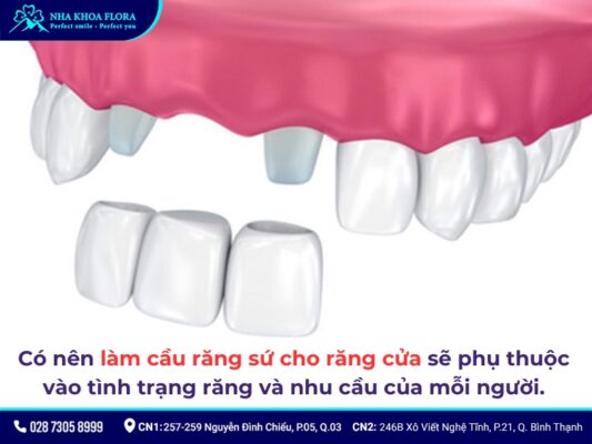 Cầu răng sứ răng cửa - ảnh 2 Cầu răng sứ răng cửa - ảnh 2