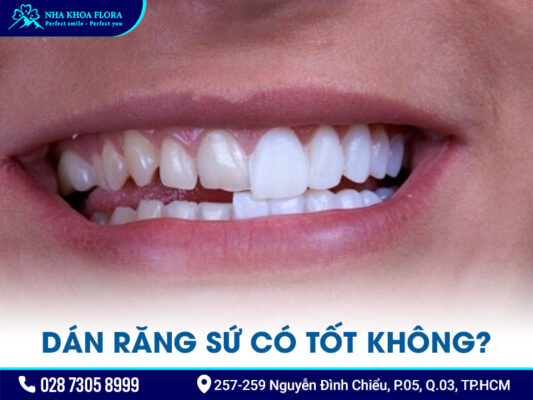 Dán răng sứ có tốt không? - ảnh 2
