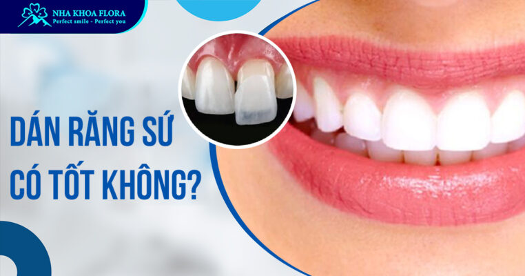 Dán răng sứ có tốt không?