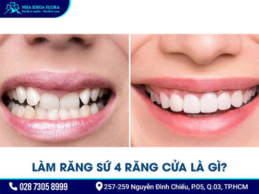Làm răng sứ 4 răng cửa - ảnh 1