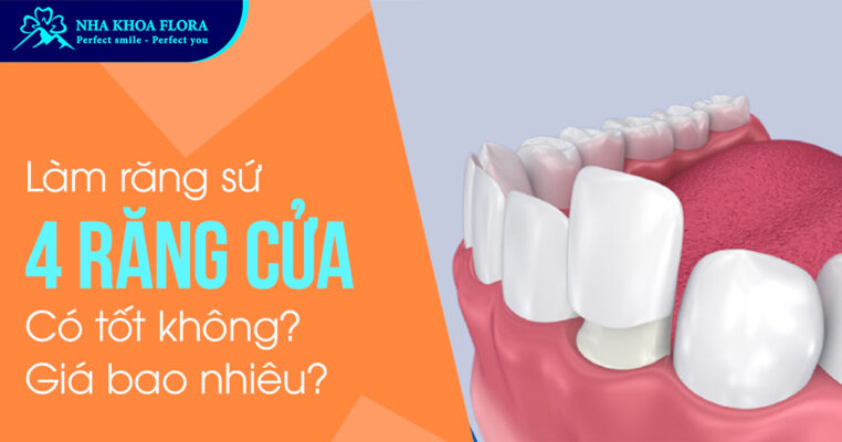 Làm răng sứ 4 răng cửa