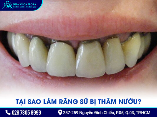 làm răng sứ bị thâm nướu - ảnh 1