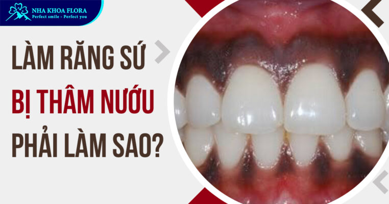 làm răng sứ bị thâm nướu
