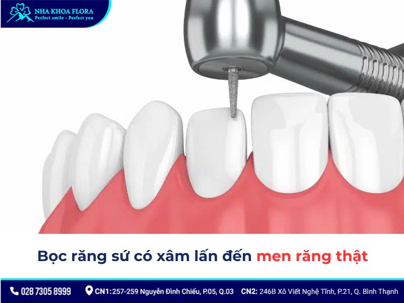 nhược điểm của việc bọc răng sứ