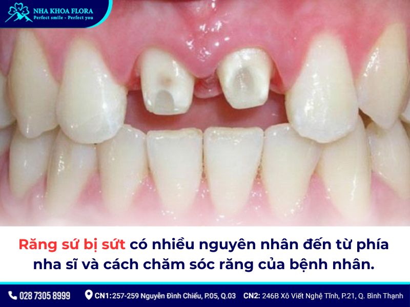 răng sứ bị sứt