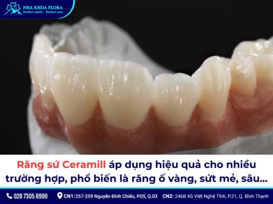 Răng sứ Ceramill - ảnh 5