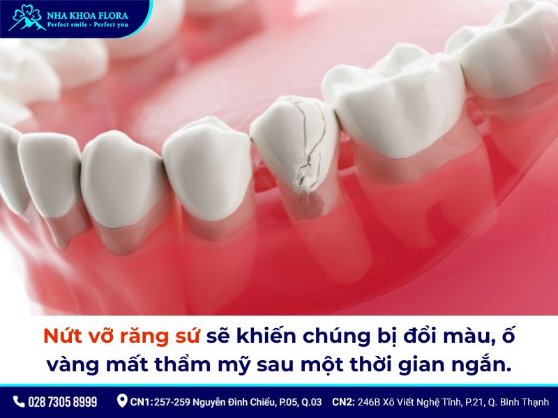 răng sứ có bị ố vàng không