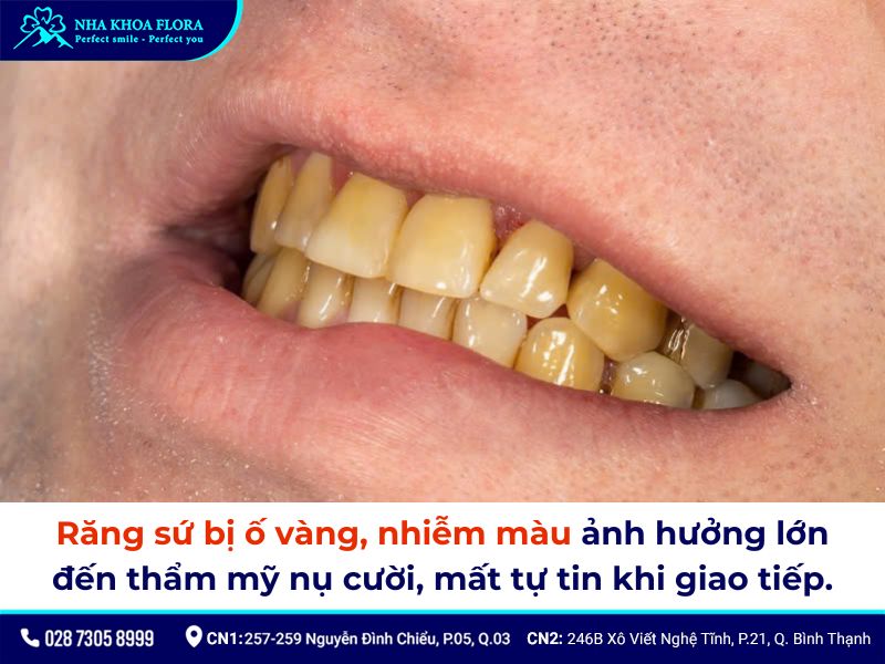 răng sứ có bị ố vàng không