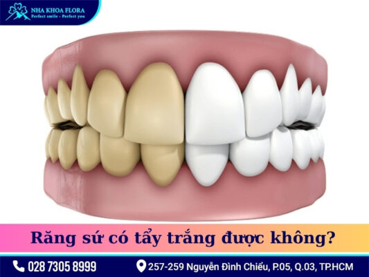Răng sứ có tẩy trắng được không - ảnh 1