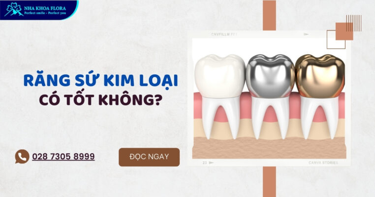 Răng sứ kim loại có tốt không?