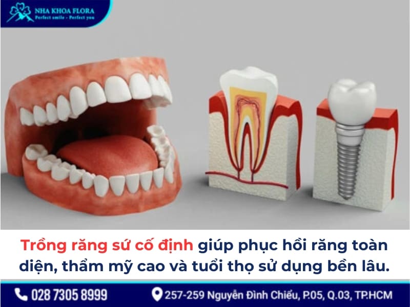 trồng răng sứ cố định