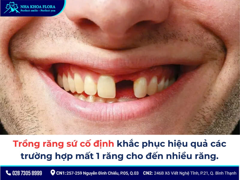 trồng răng sứ cố định