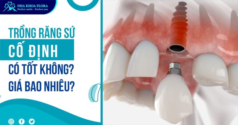 trồng răng sứ cố định