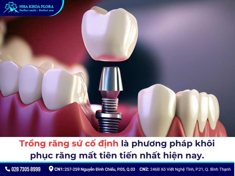 trồng răng sứ cố định