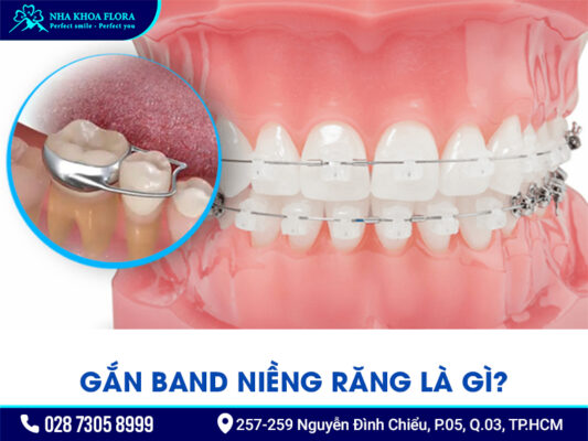 Band niềng răng - ảnh 1