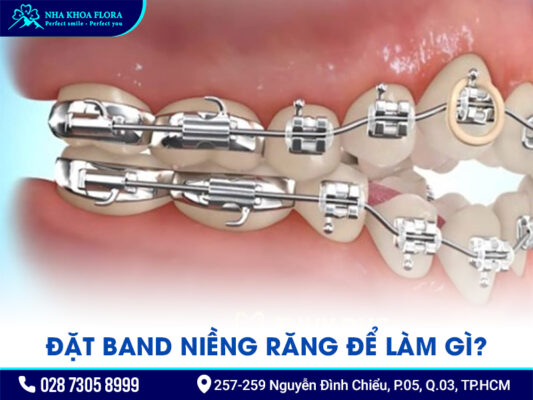 Band niềng răng - ảnh 2