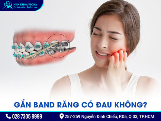 Band niềng răng - ảnh 4