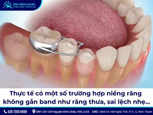 Band niềng răng - ảnh 5