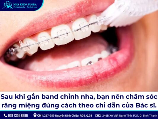Band niềng răng - ảnh 6