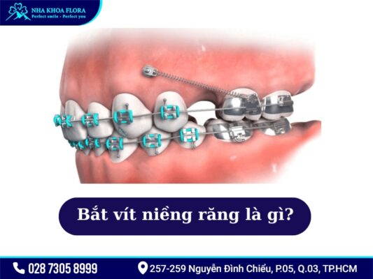 Bắt vít niềng răng - ảnh 1