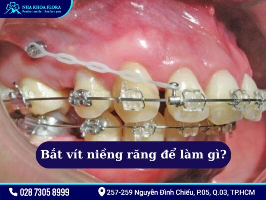 Bắt vít niềng răng - ảnh 2