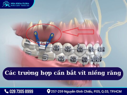 Bắt vít niềng răng - ảnh 3