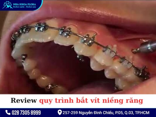 Bắt vít niềng răng - ảnh 4
