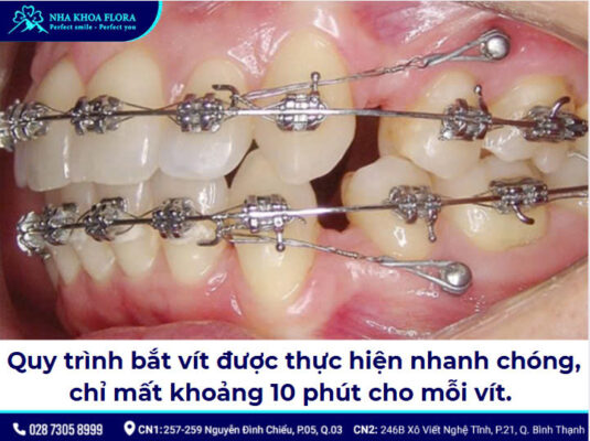 Bắt vít niềng răng - ảnh 5
